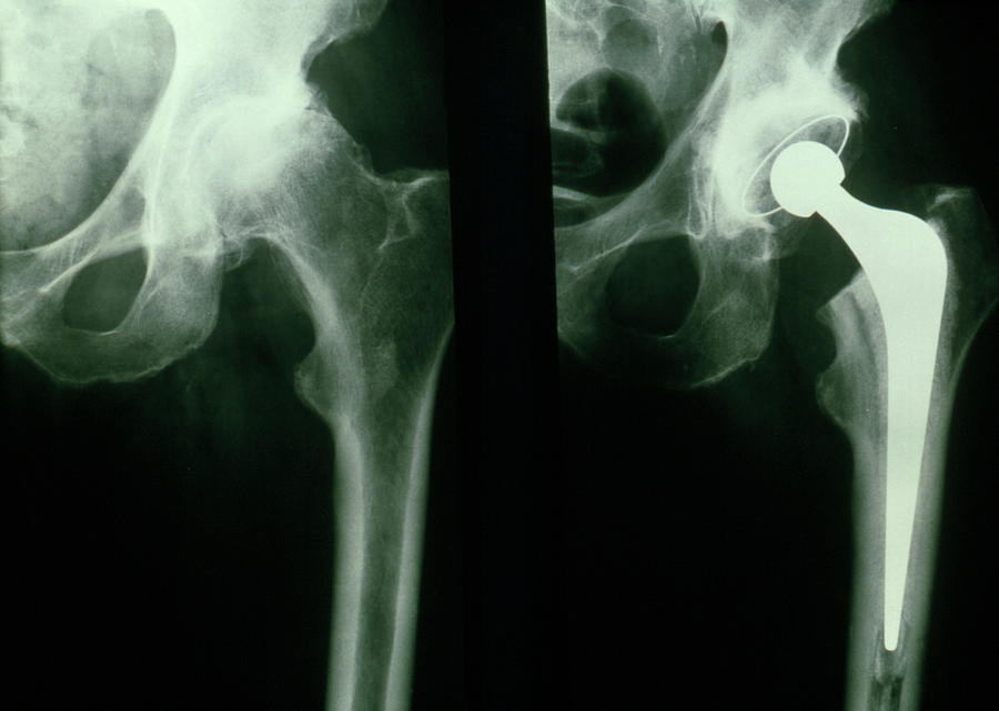Why Choose hip replacement